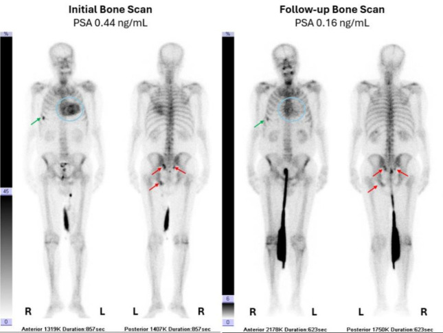 Unexplained Cardiac Uptake on <sup>99m</sup>Tc-MDP Bone Scan in a Patient with Prostate Cancer.