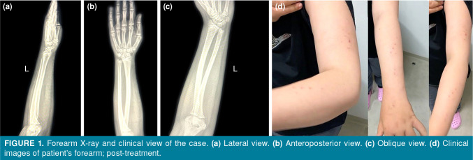 To perform or not to perform fasciotomy? A rare case report.
