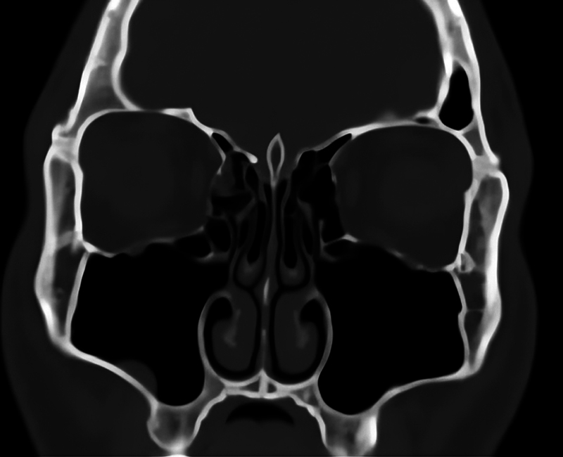 Description of the Uncinate Process: A Computed Tomography Cross-Sectional Study.