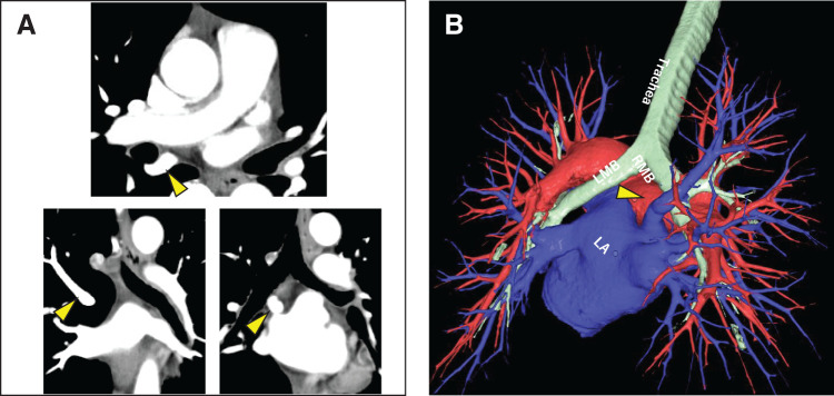 Impact of Right Top Pulmonary Vein Location on Subcarinal Lymph Node Dissection in Thoracoscopic Esophagectomy: A Case Report and Literature Review.