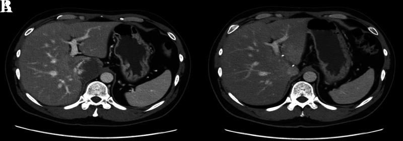Robotic Caudate Lobectomy: Feasibility and Techniques with Da Vinci Xi and SP Systems.