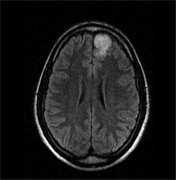 Behind the veil: Glioma presenting as delusional disorder.