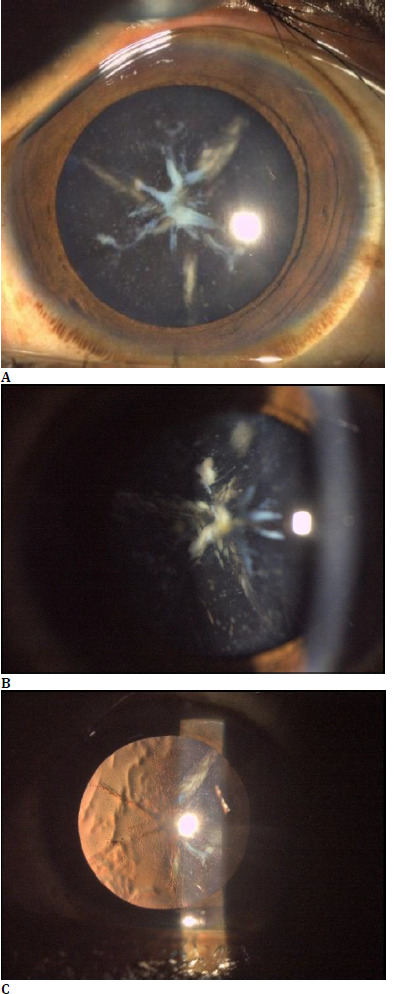 Blue dot cataract with Sutural cataract: A rare association and its management.