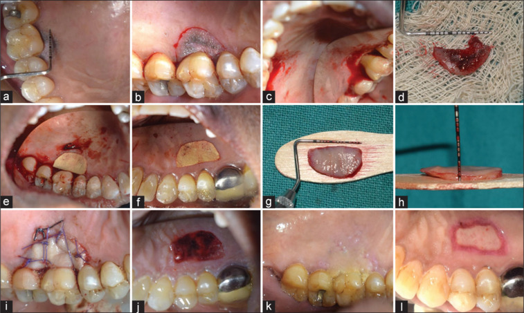Management of leukoplakia of palatal gingiva using free gingival graft.