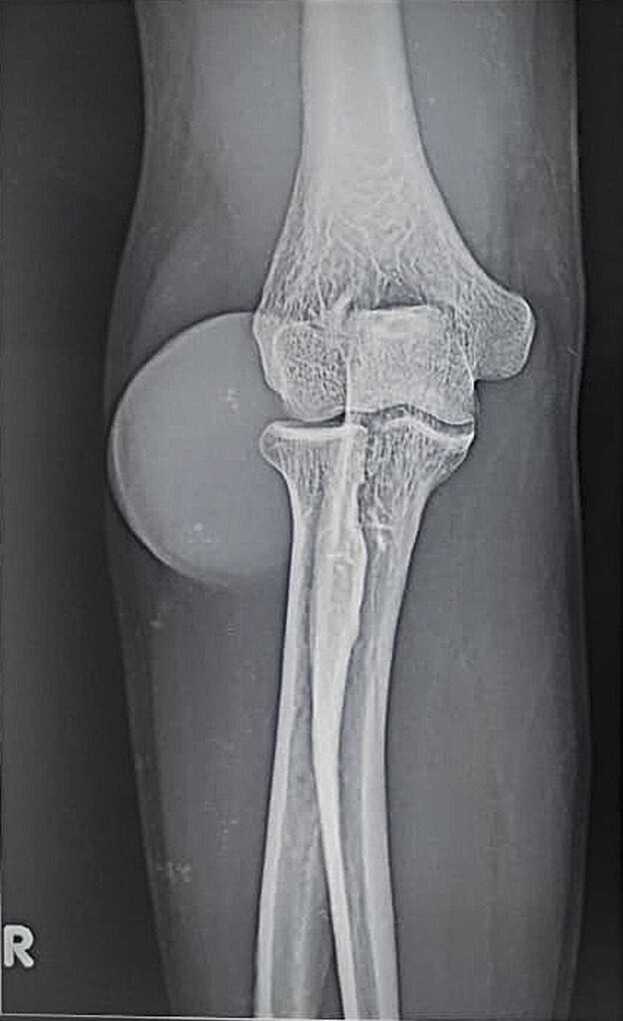 Mycotic cyst: Case report