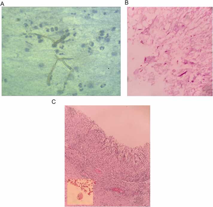 Mycotic cyst: Case report