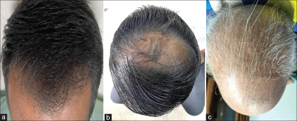 Evaluating the Role of the Gabrin Sign in Predicting COVID-19 Severity Among Patients with Androgenic Alopecia.