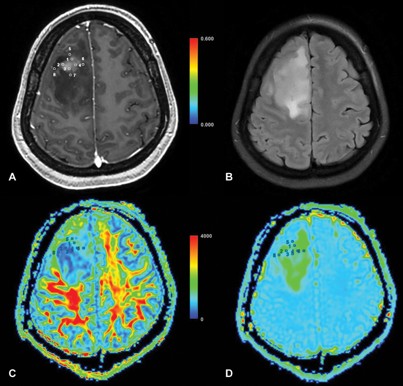 Utilizing Diffusion Tensor Imaging to Differentiate High-Grade Gliomas and Solitary Brain Metastases.