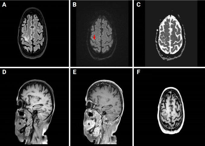 Progressive multifocal leukoencephalopathy, the role of the susceptibility-weighted imaging sequence in a case of immunosuppression of an initially unknown cause.