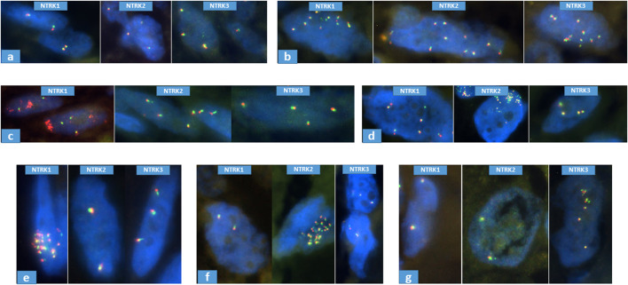 NTRK amplification occurs frequently in pan-TRK immunopositive dedifferentiated liposarcomas.