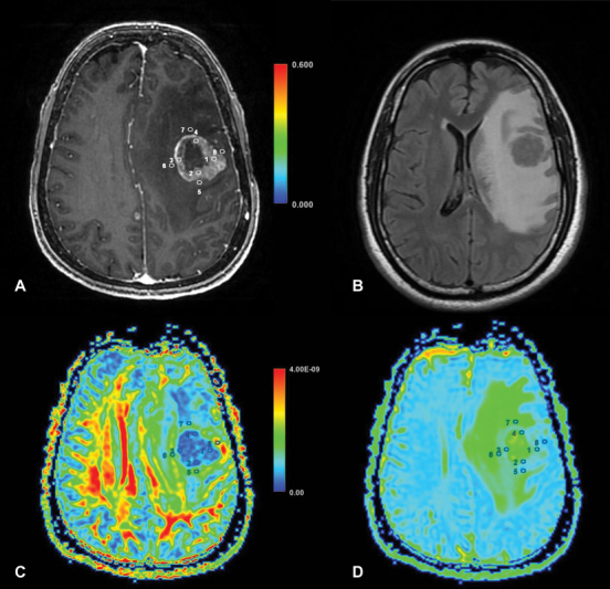 Utilizing Diffusion Tensor Imaging to Differentiate High-Grade Gliomas and Solitary Brain Metastases.