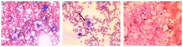 Case Report: Two Cases of Kikuchi Disease in West Texas With Non-Self-Limited Disease.