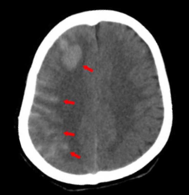 McArdle's disease presents with multiple large vessel lesions.