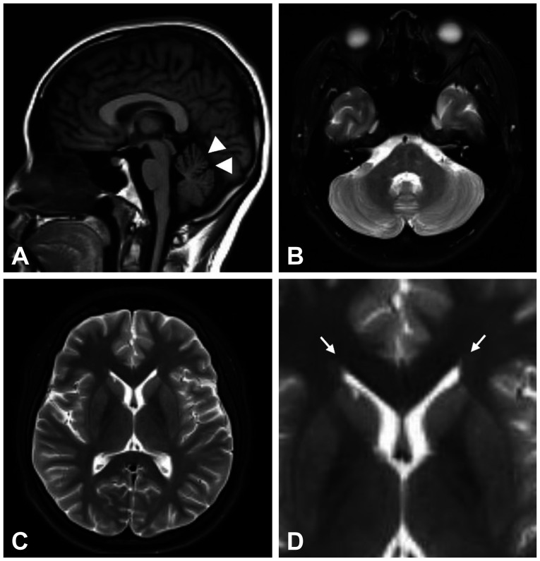 "Ear of the Lynx" Sign in Hereditary Spastic Paraplegia 76.