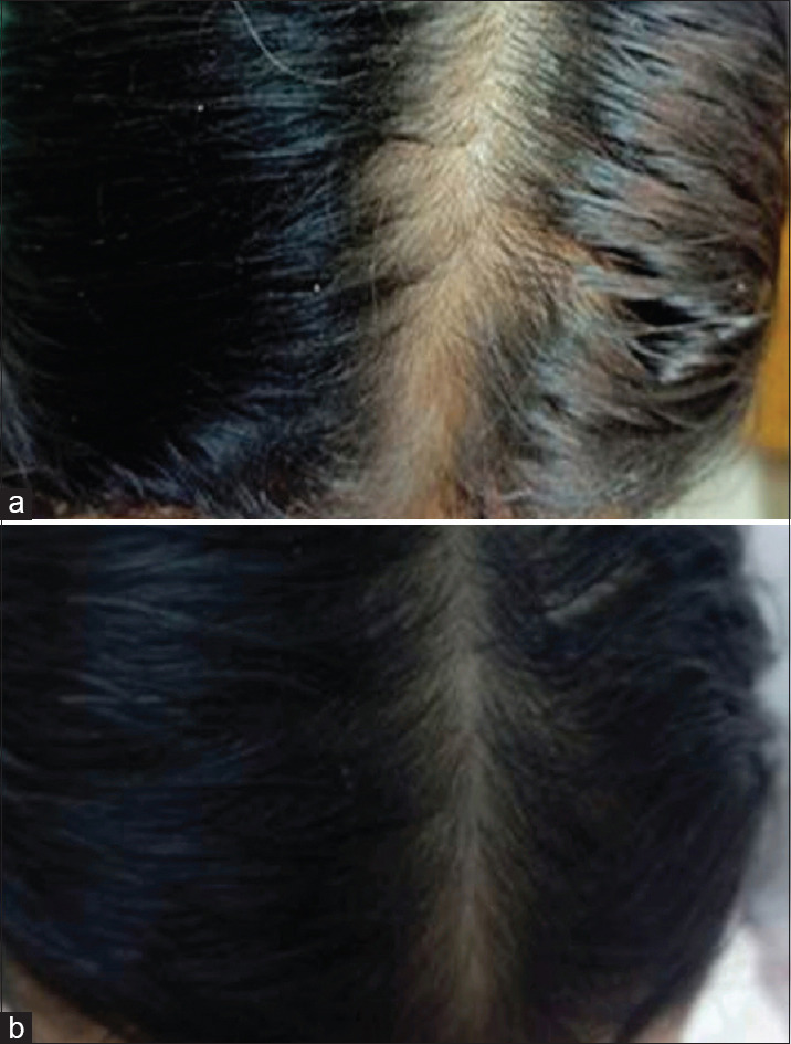 Evaluation of the Efficacy and Safety of Topical Spironolactone versus Topical Minoxidil in the Treatment of Female Pattern Hair Loss: A Comparative, Clinical, and Trichoscopic Study.