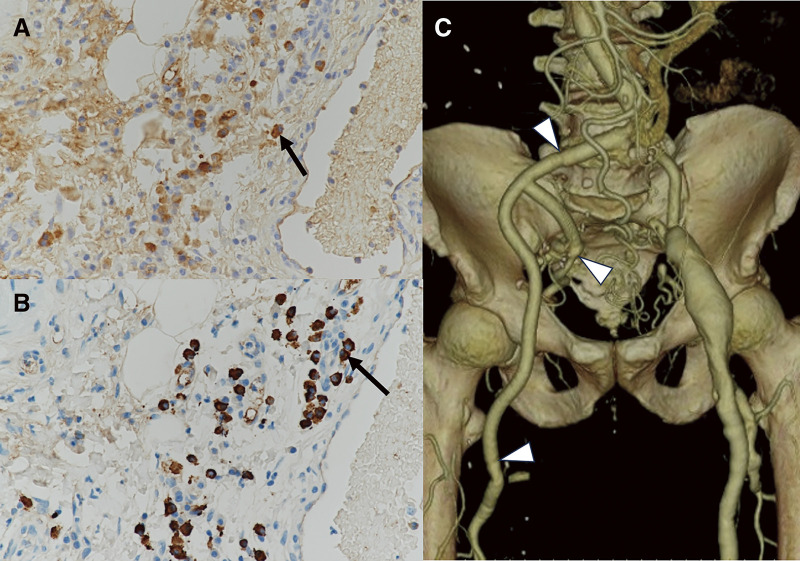 Common Femoral Artery Aneurysm: A Rare Manifestation of Immunoglobulin G4-Related Disease.