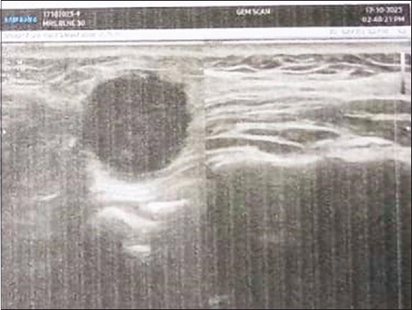 Angioleiomyoma of cheek - A case report highlighting immunohistochemical diagnostic approach.