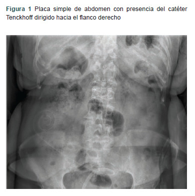 [Tenckhoff catheter placed in bladder. Case and review].