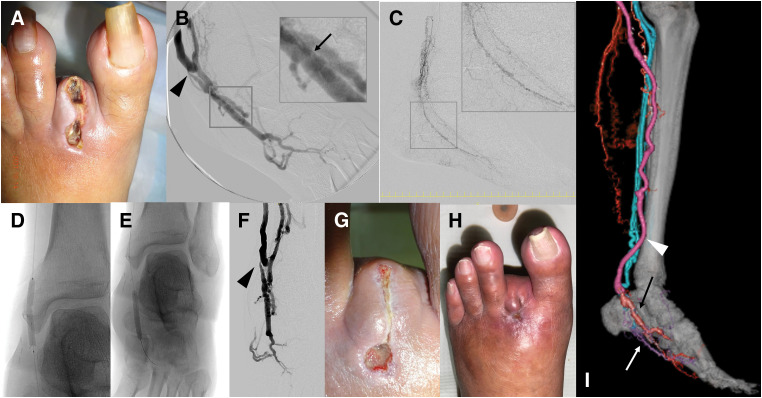 Combined Arterial Reconstruction and Surgical Distal Venous Arterialization for Limb Salvage in Thromboangiitis Obliterans: A Case Report.