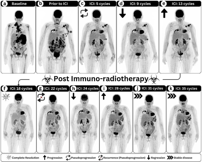 Complex immunotherapy-mediated response patterns depicted on serial <sup>18</sup>F-FDG PET imaging of Hodgkin lymphoma patient undergoing pembrolizumab therapy.