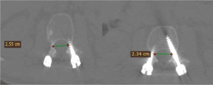 Validity of a new scoring system for assessment and decision guidance of misplaced pedicular screws.
