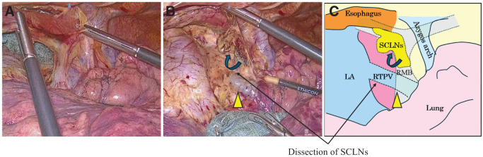 Impact of Right Top Pulmonary Vein Location on Subcarinal Lymph Node Dissection in Thoracoscopic Esophagectomy: A Case Report and Literature Review.