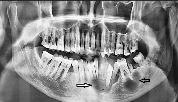 Unravelling a solitary gingival swelling: A unique case report of clear cell calcifying epithelial odontogenic tumour.
