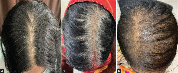 Evaluating the Role of the Gabrin Sign in Predicting COVID-19 Severity Among Patients with Androgenic Alopecia.
