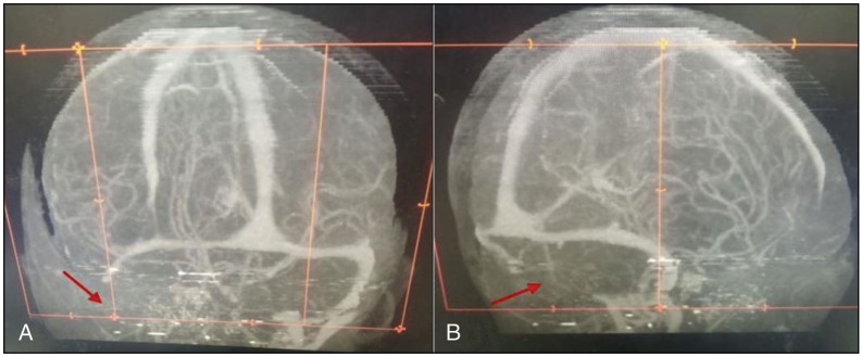 Cerebral Venous Sinus Thrombosis and Helminthiasis. A Case-Based Review.