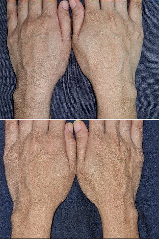 Acquired Localized Hypertrichosis Following Cast Application for Fracture.