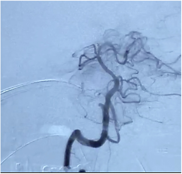 Beyond the Limit: Salvaging the Posterior Circulation Territory via Late Endovascular Thrombectomy.