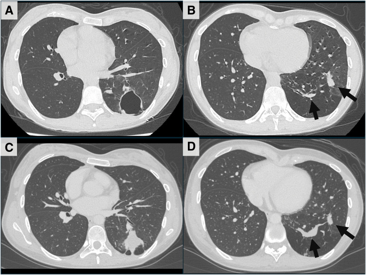Congenital Pulmonary Airway Malformation with Pulmonary Arteriovenous Malformation in Adulthood: A Case Report.