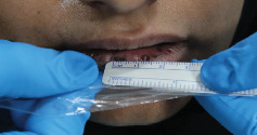 Lip Melanosis Postdermal Filler Injection: Second Case Report and Literature Review.