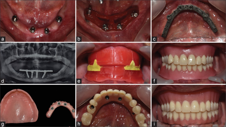 Prosthodontic rehabilitation of resorbed mandibular ridges using guided all-on-four technique and implant retained overdentures-A case series.