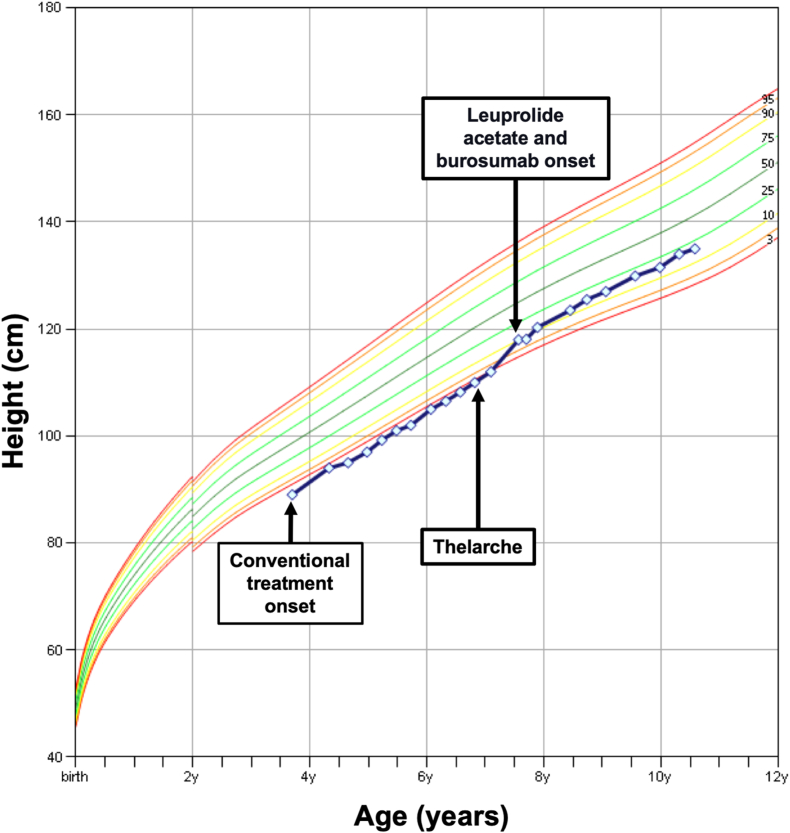 Combined Treatment With Leuprolide Acetate and Burosumab in X-linked Hypophosphatemia and Precocious Puberty: A Therapeutic Response