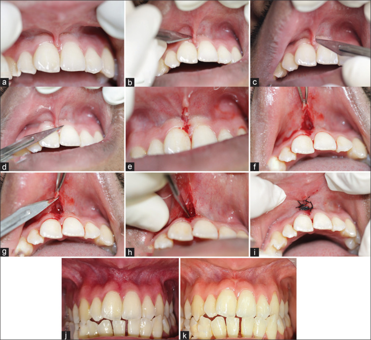 Evaluation of esthetics, pain scores, and prognosis of modified paralleling technique for high frenal attachment: A case series.