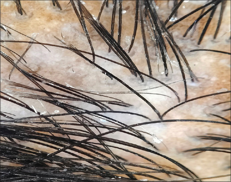 Grooming Our Knowledge on "Broom Hairs" - Dermoscopy of Trichoteiromania.