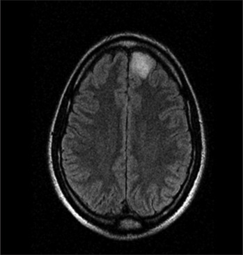 Behind the veil: Glioma presenting as delusional disorder.