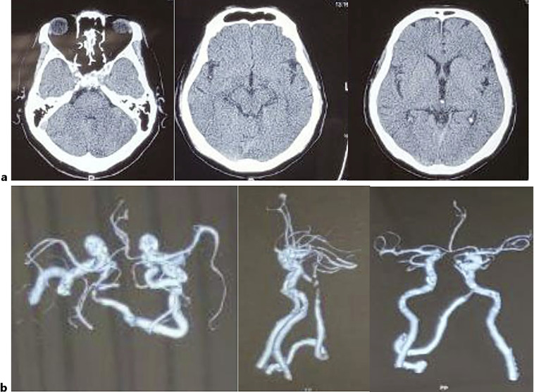 Beyond the Limit: Salvaging the Posterior Circulation Territory via Late Endovascular Thrombectomy.