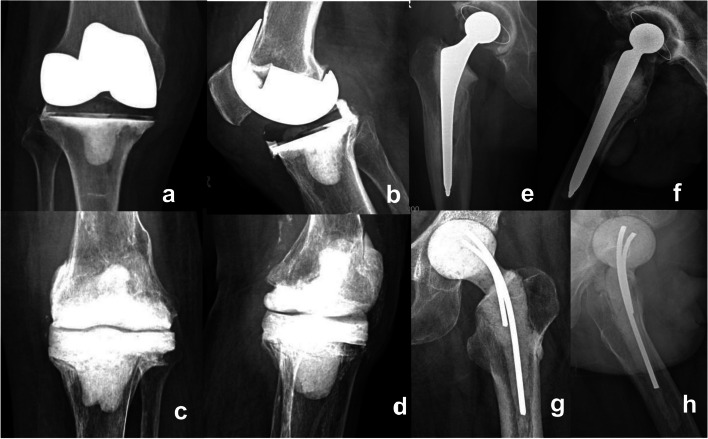Prosthetic articulating spacers as a preferred option for two-stage revision arthroplasty in chronic periprosthetic joint infection.