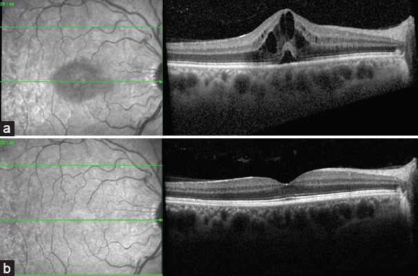 A review on anterior uveitis and spondyloarthritis with a focus on the interdisciplinary approach between ophthalmologists and rheumatologists.