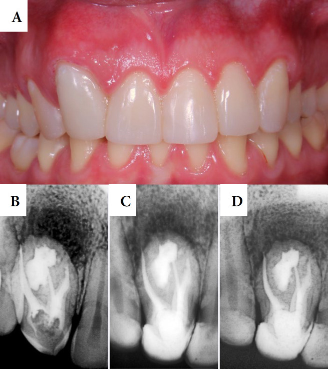 Endodontic Treatment of an Upper Lateral Incisor with Oehlers' Type II Dens Invaginatus: A Case Report.