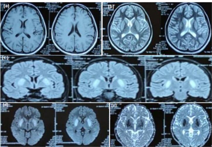 Epstein-Barr Virus Encephalitis as a Cause of Status Epilepticus - A Rare Encounter.