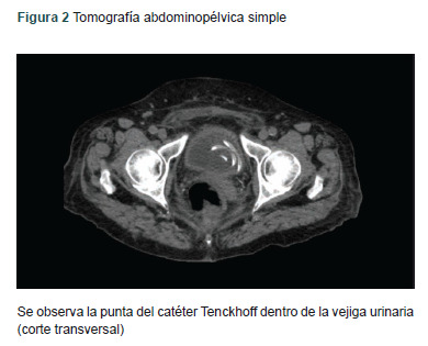 [Tenckhoff catheter placed in bladder. Case and review].