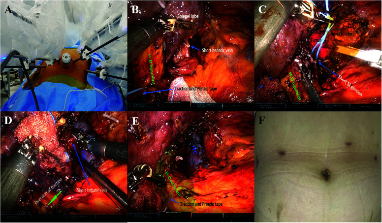 Robotic Caudate Lobectomy: Feasibility and Techniques with Da Vinci Xi and SP Systems.