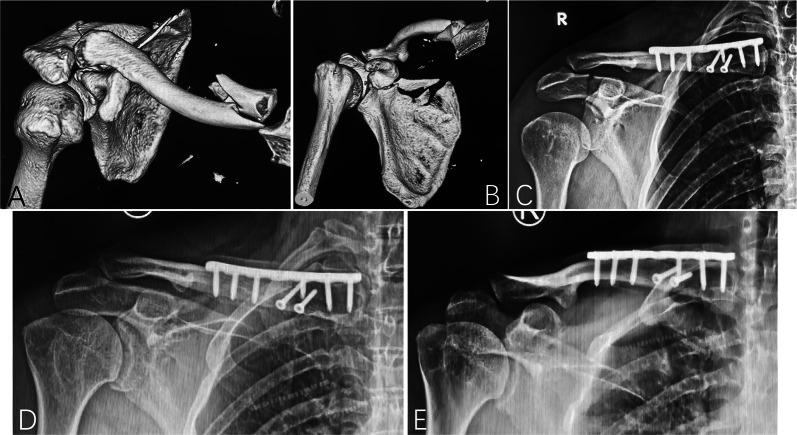 Ipsilateral concomitant fractures of the clavicle and coracoid process of the scapula: incidence, characteristics, and outcomes.