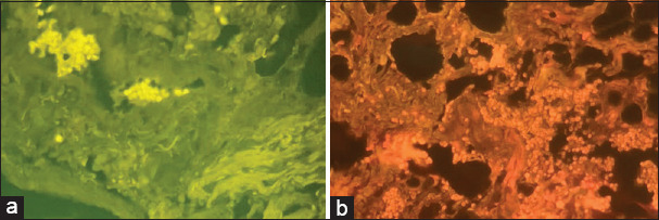 Comparative evaluation of staining efficacy of calcofluor white and acridine orange in detecting fungal elements in oral potentially malignant disorders and oral squamous cell carcinoma - A retrospective study.