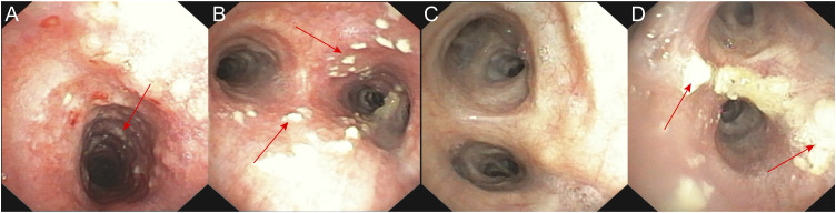 Tracheal mucosal keratosis: Case discussion and literature review.