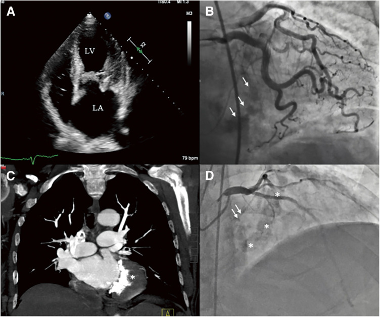 "A Bridge-over-the Bar": A Novel Strategy to Prevent Paravalvular Regurgitation during Mitral Valve Replacement for Severe Mitral Annular Calcifications.
