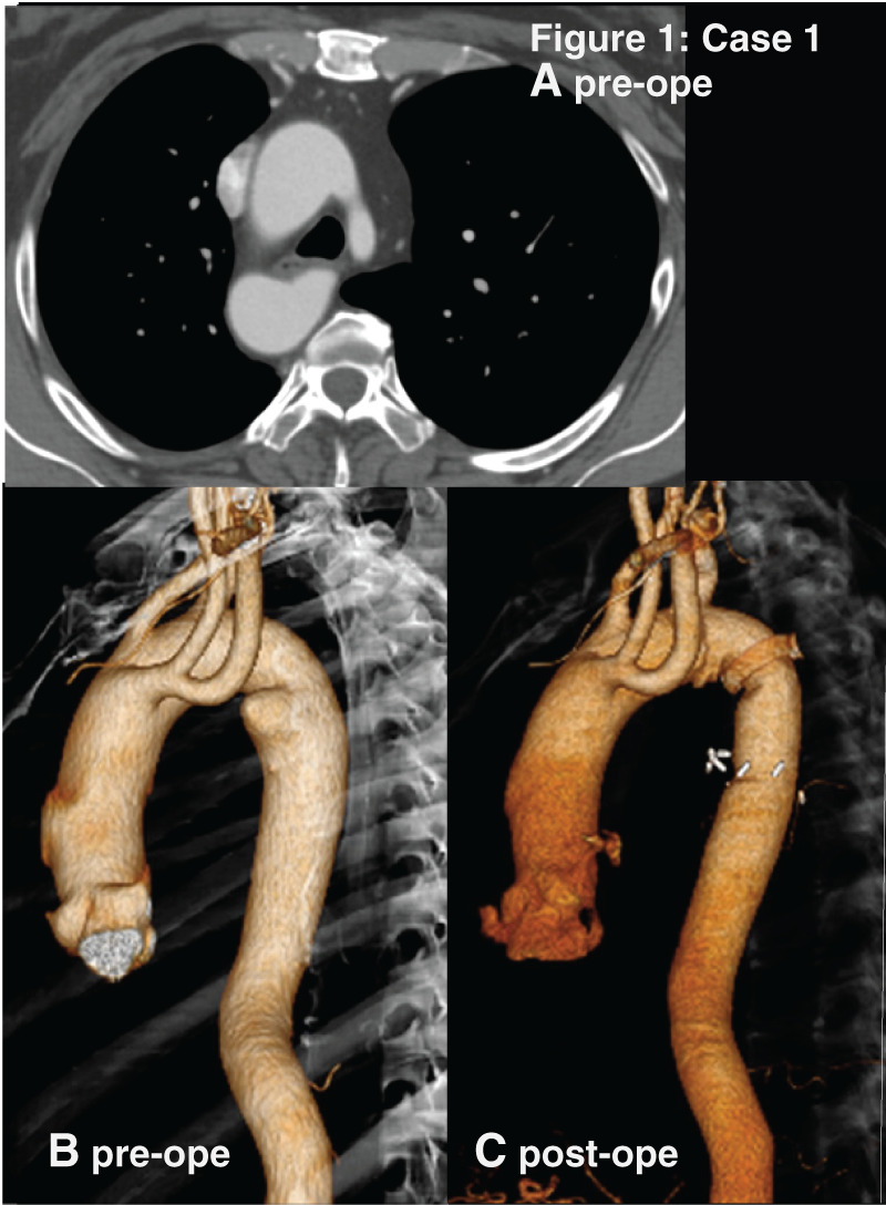 Optimal Surgical Strategy for Kommerell's Diverticulum Associated with a Right-Sided Aortic Arch: A Report of Four Cases.